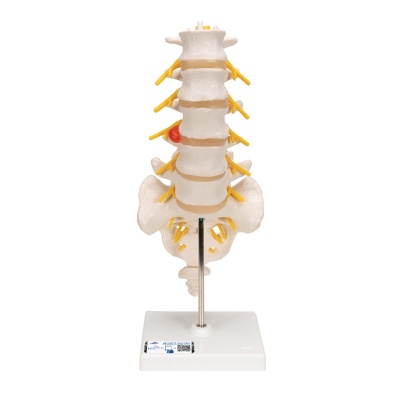 Anatomical Human Lumbar Vertebrae Degenerative Disc Disease Model - Products - Medical Models Anatomical Human Lumbar Vertebrae Degenerative Disc Disease Model - Products - Medical Models